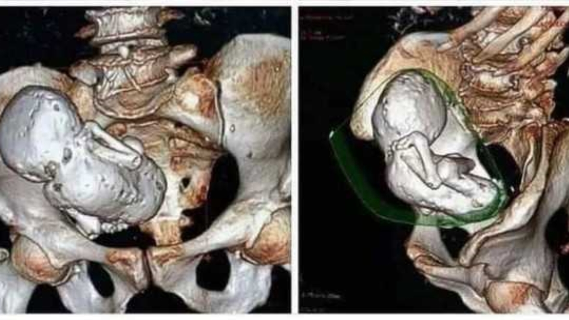 Read more about the article பெண்ணின் வயிற்றில் 30 வருஷமா இருந்து கல்லாக மாறிய குழந்தை! மெய்சிலிர்க்கும் அதிசயம்