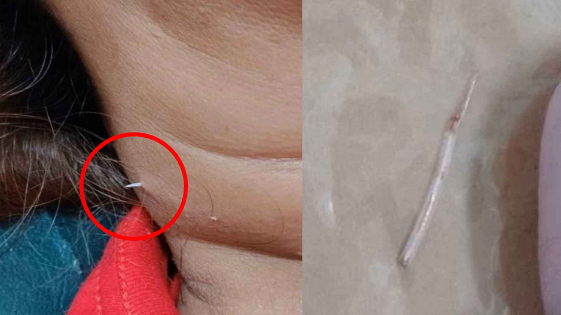 Read more about the article <span class="photo-label">🔴 PHOTO</span> பெண்ணின் கழுத்தை கிழித்து கொண்டு வெளியே வந்த மீன் முள்