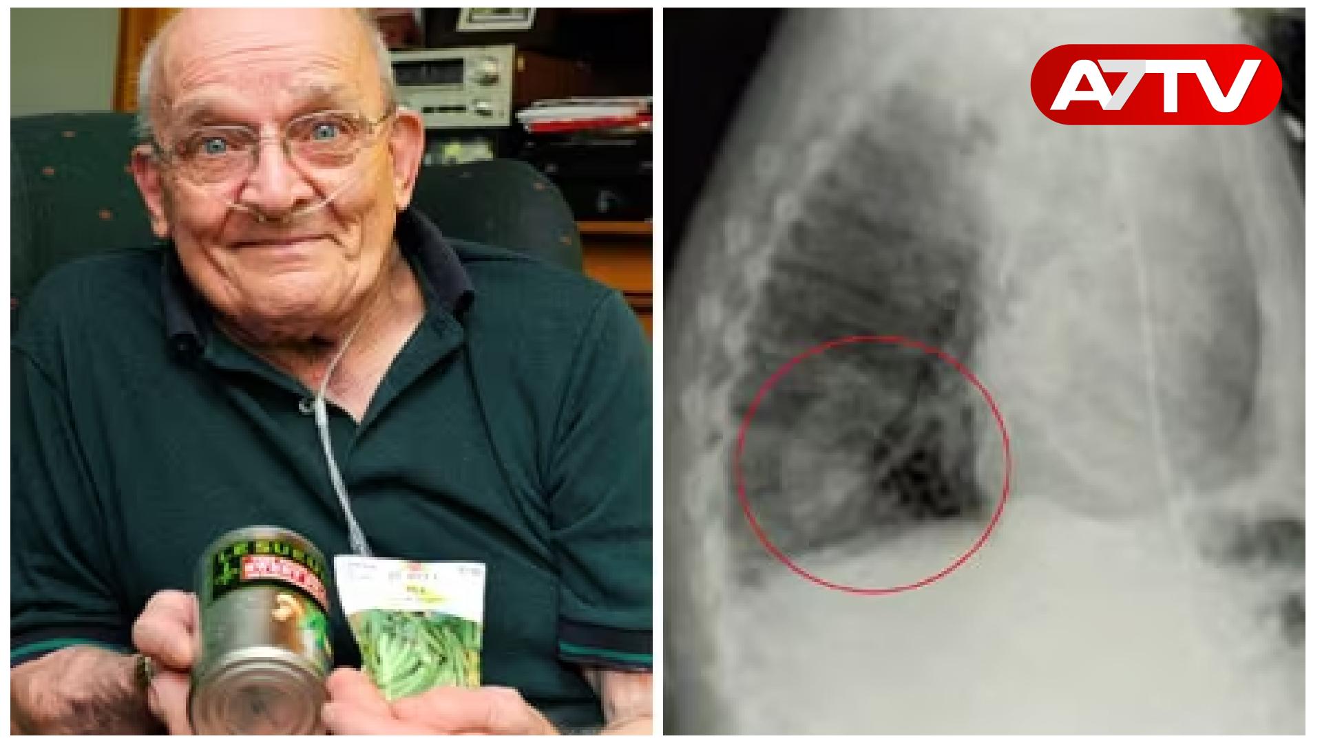 Read more about the article மனித நுரையீரலில் வளர்ந்த செடி: வரலாற்றில் இடம்பிடித்த சம்பவம்